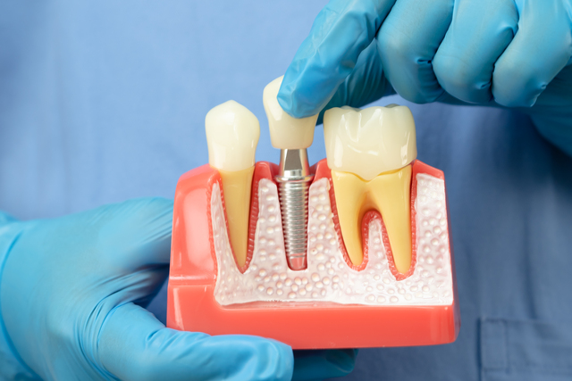 implantes dentales en que consisten