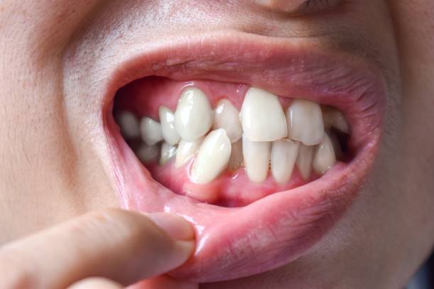 Apiñamiento dental que es