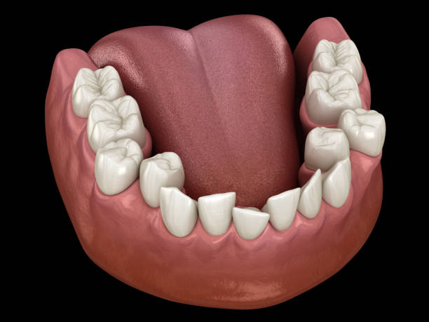 Apiñamiento dental