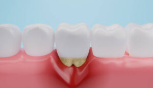 Periodoncia en Badajoz