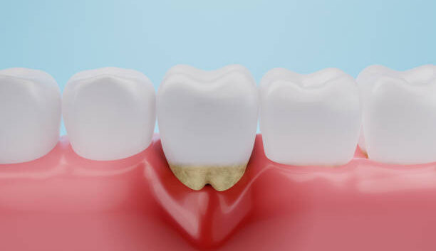 Periodoncia en Badajoz