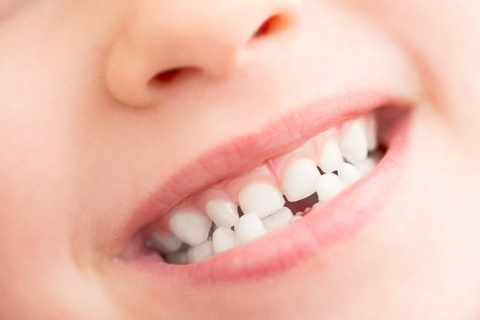 extracción de dientes de leche