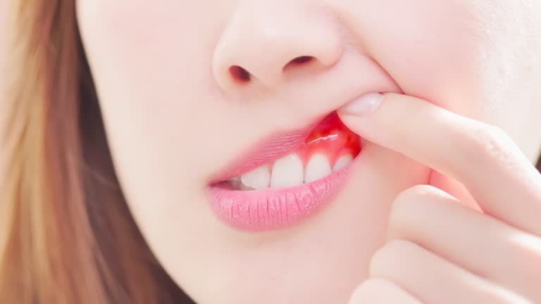 Gingivitis