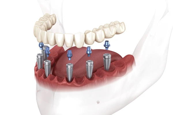 implantes dentales all on 6