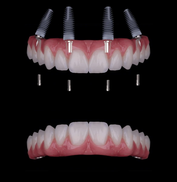 implante all on 4