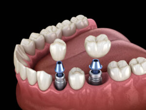 implantes dentales de titanio